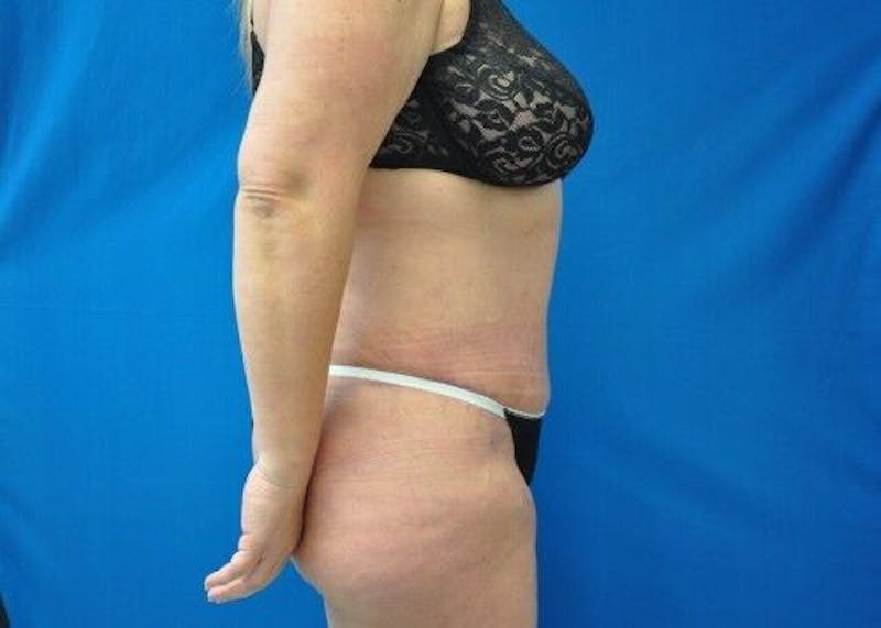 Tummy Tuck Before & After Gallery - Patient 55345413 - Image 8