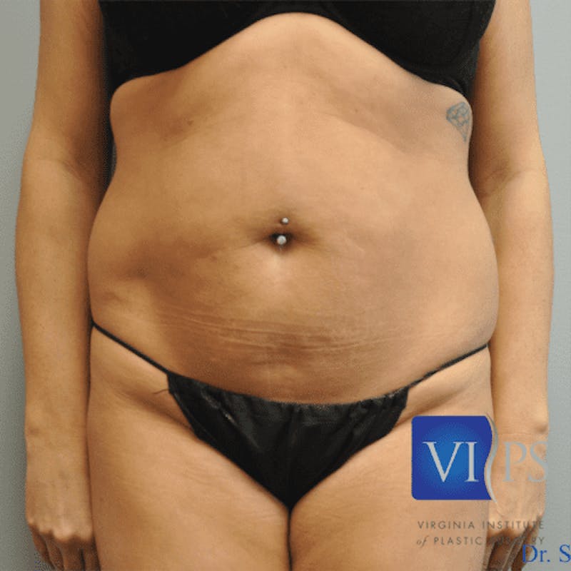 Renuvion J-Plasma Before & After Gallery - Patient 211876540 - Image 1