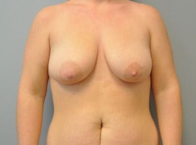 Breast Augmentation with Lift Before & After Gallery - Patient 55345422 - Image 1