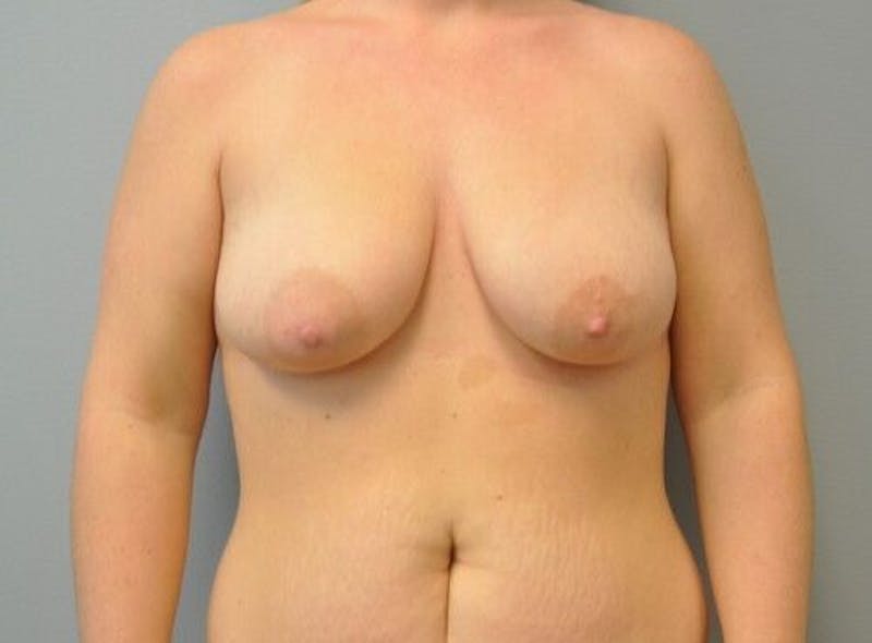 Breast Augmentation with Lift Before & After Gallery - Patient 55345422 - Image 1