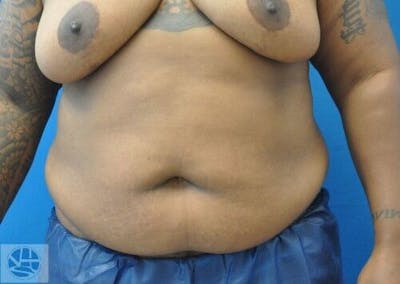 Extended Tummy Tuck Before & After Gallery - Patient 273932 - Image 1