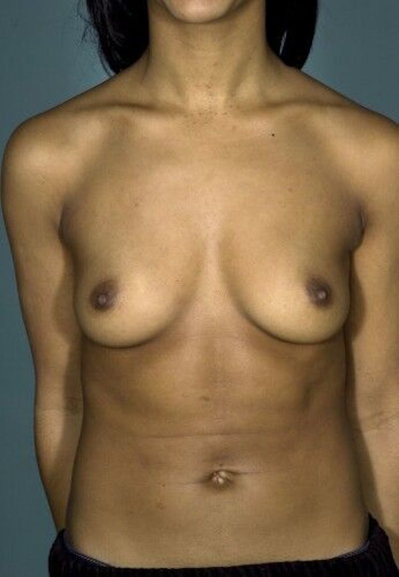 Breast Augmentation Before & After Gallery - Patient 55345419 - Image 1