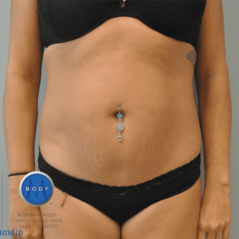 Liposuction Before & After Gallery - Patient 211876582 - Image 2