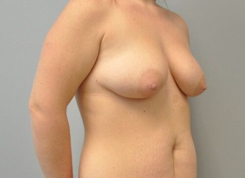 Breast Augmentation with Lift Before & After Gallery - Patient 55345422 - Image 3