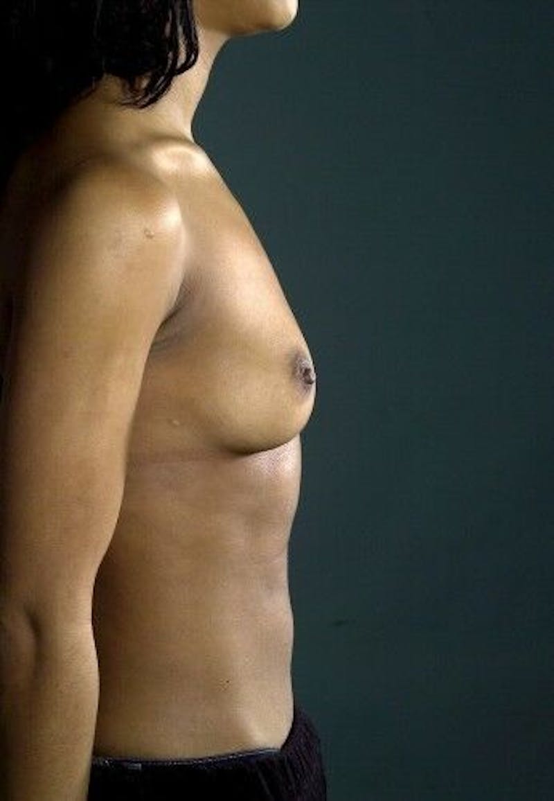 Breast Augmentation Before & After Gallery - Patient 55345419 - Image 3