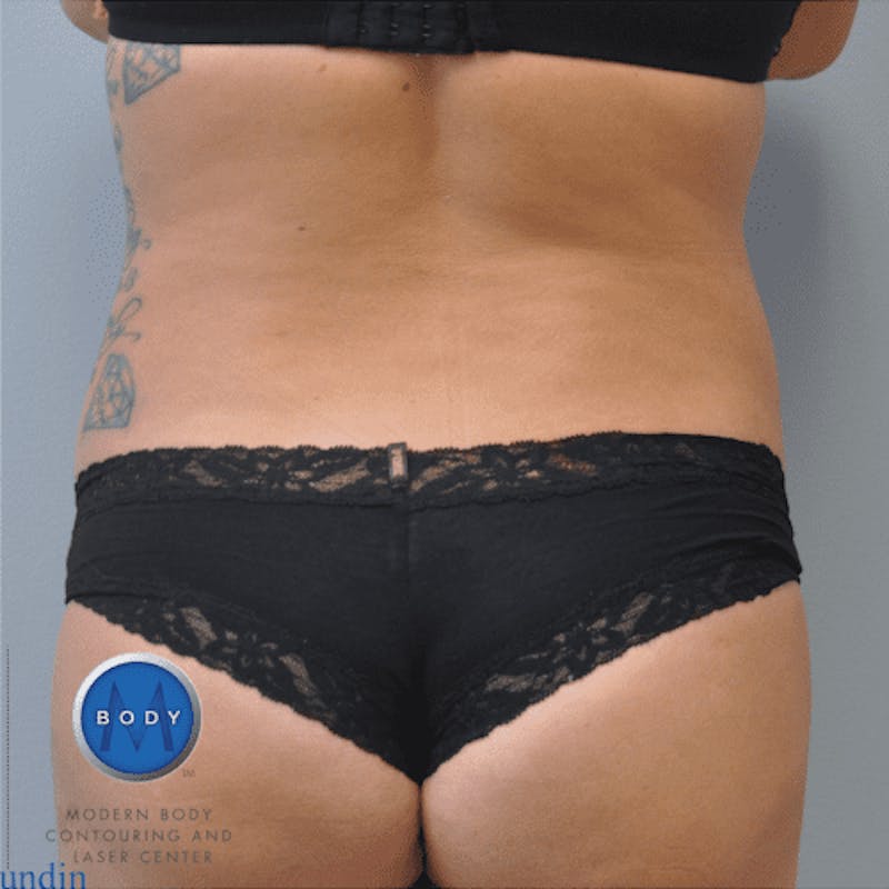 Renuvion J-Plasma Before & After Gallery - Patient 211876540 - Image 4