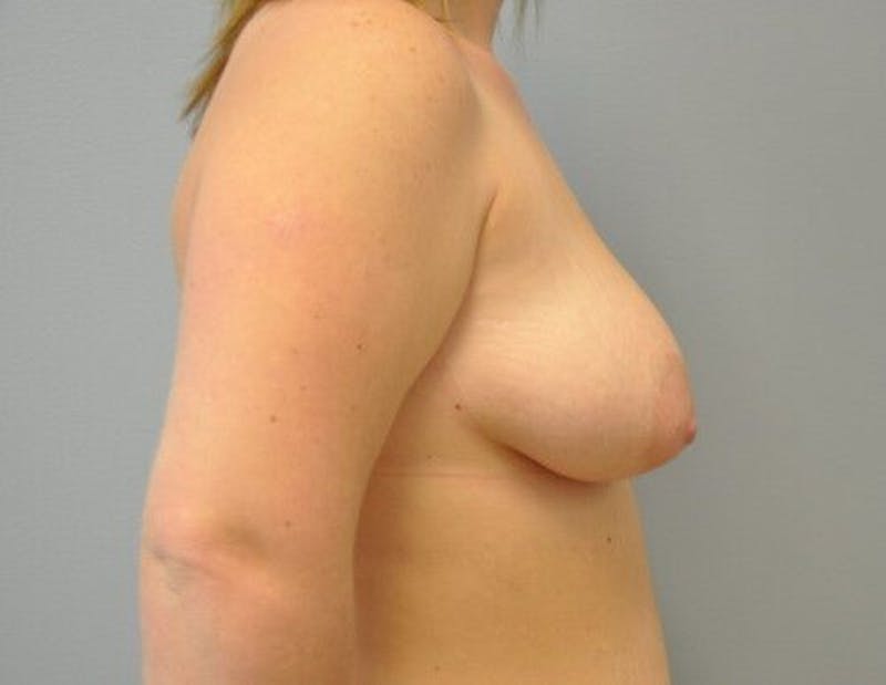 Breast Augmentation with Lift Before & After Gallery - Patient 55345422 - Image 5