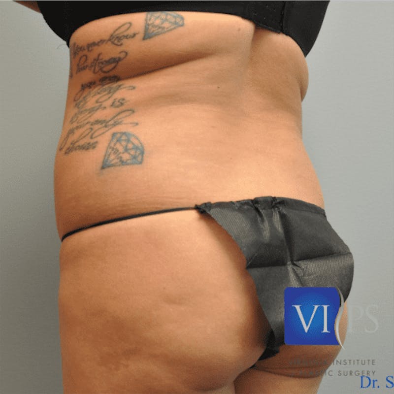 Liposuction Before & After Gallery - Patient 211876582 - Image 5