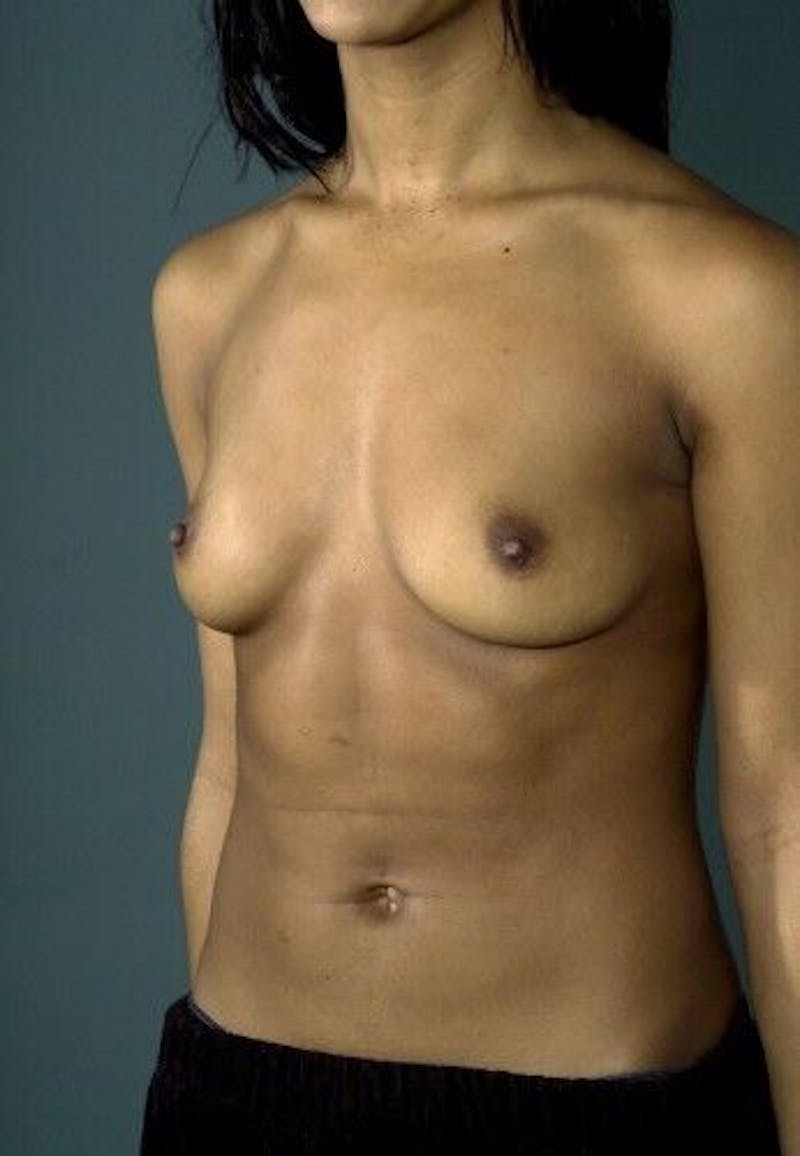 Breast Augmentation Before & After Gallery - Patient 55345419 - Image 5