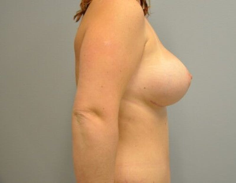 Breast Augmentation with Lift Before & After Gallery - Patient 55345422 - Image 6