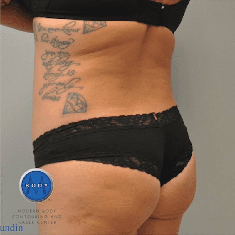 Liposuction Before & After Gallery - Patient 211876582 - Image 6