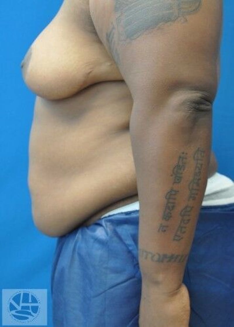 Tummy Tuck Before & After Gallery - Patient 55345423 - Image 7