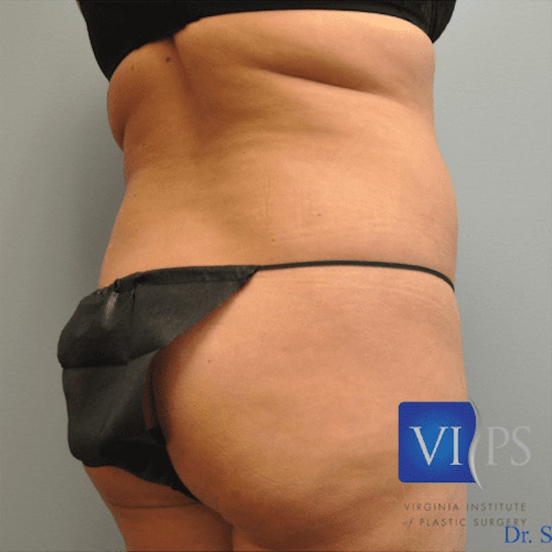 Renuvion J-Plasma Before & After Gallery - Patient 211876540 - Image 7