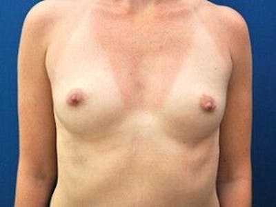 Breast Augmentation Before & After Gallery - Patient 55345426 - Image 1