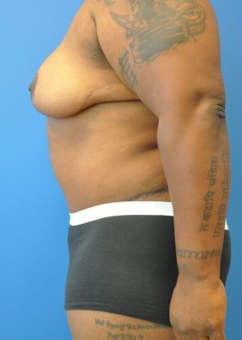 Tummy Tuck Before & After Gallery - Patient 55345423 - Image 8