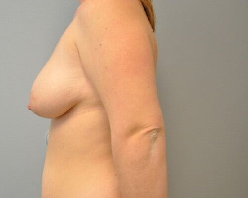 Breast Augmentation with Lift Before & After Gallery - Patient 55345422 - Image 9