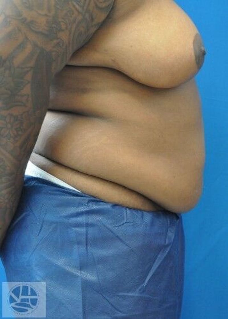 Tummy Tuck Before & After Gallery - Patient 55345423 - Image 9