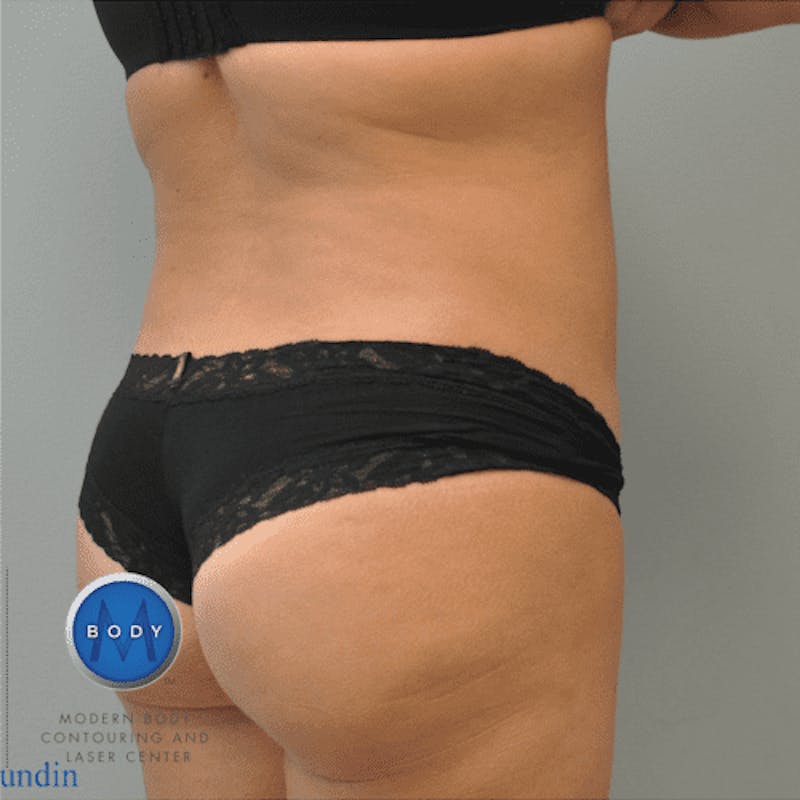Liposuction Before & After Gallery - Patient 211876582 - Image 8