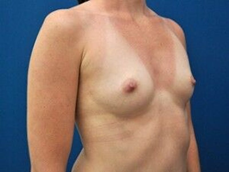 Breast Augmentation Before & After Gallery - Patient 55345426 - Image 3