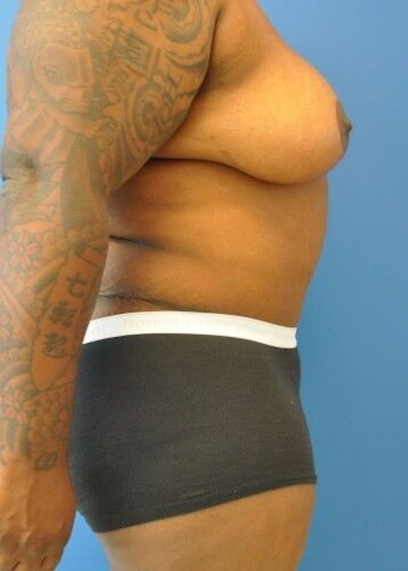 Tummy Tuck Before & After Gallery - Patient 55345423 - Image 10