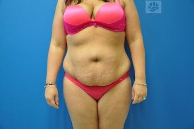 Tummy Tuck Before & After Gallery - Patient 55345429 - Image 1