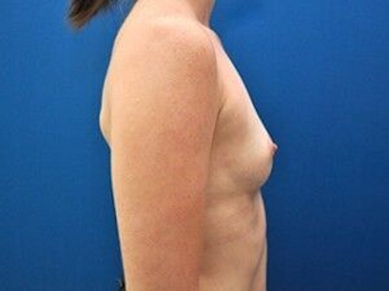 Breast Augmentation Before & After Gallery - Patient 55345426 - Image 5