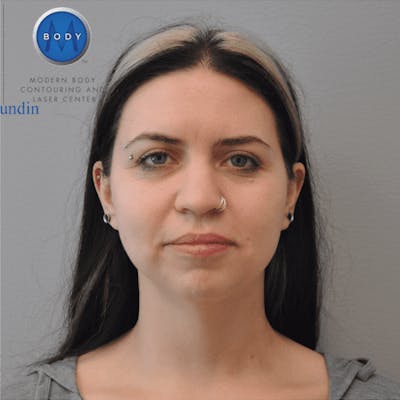 Renuvion J-Plasma Before & After Gallery - Patient 211876557 - Image 2