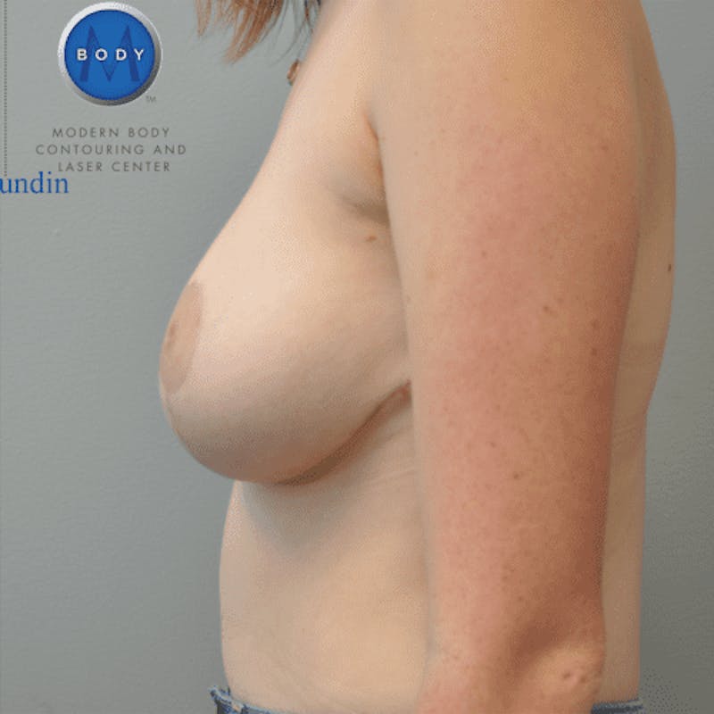 Breast Reduction Before & After Gallery - Patient 55345424 - Image 6