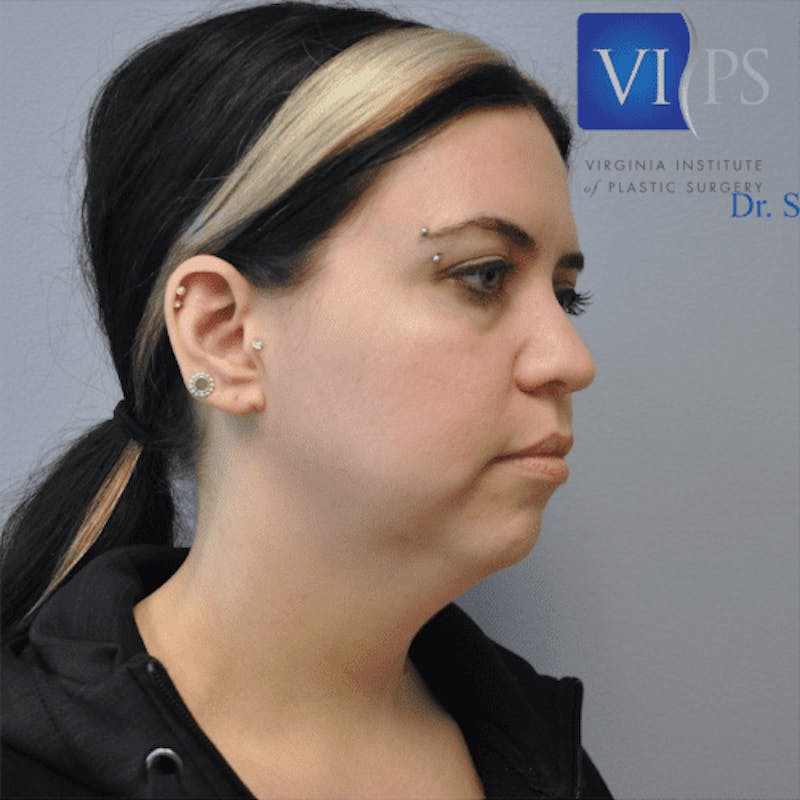 Renuvion J-Plasma Before & After Gallery - Patient 211876557 - Image 3