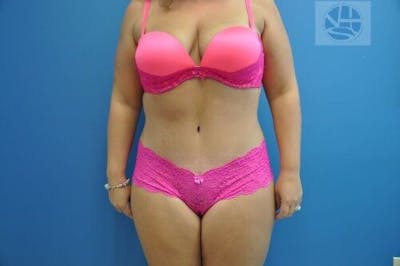 Tummy Tuck Before & After Gallery - Patient 55345429 - Image 2