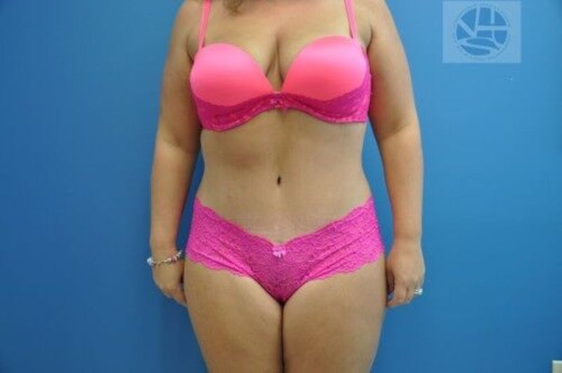 Tummy Tuck Before & After Gallery - Patient 55345429 - Image 2