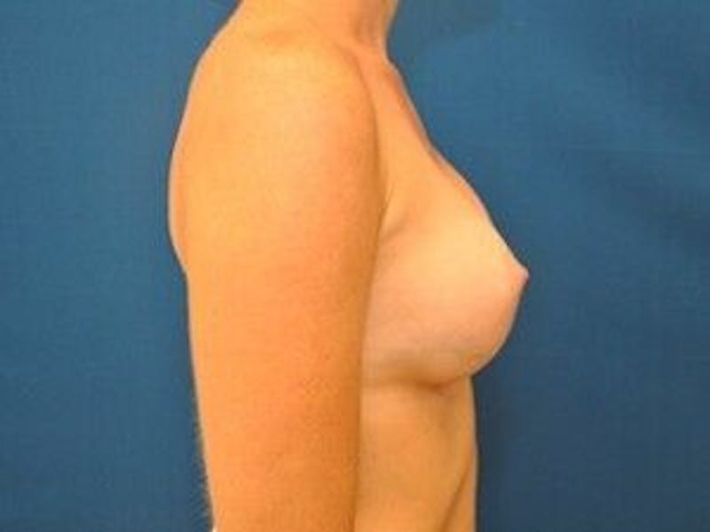 Breast Augmentation Before & After Gallery - Patient 55345426 - Image 6