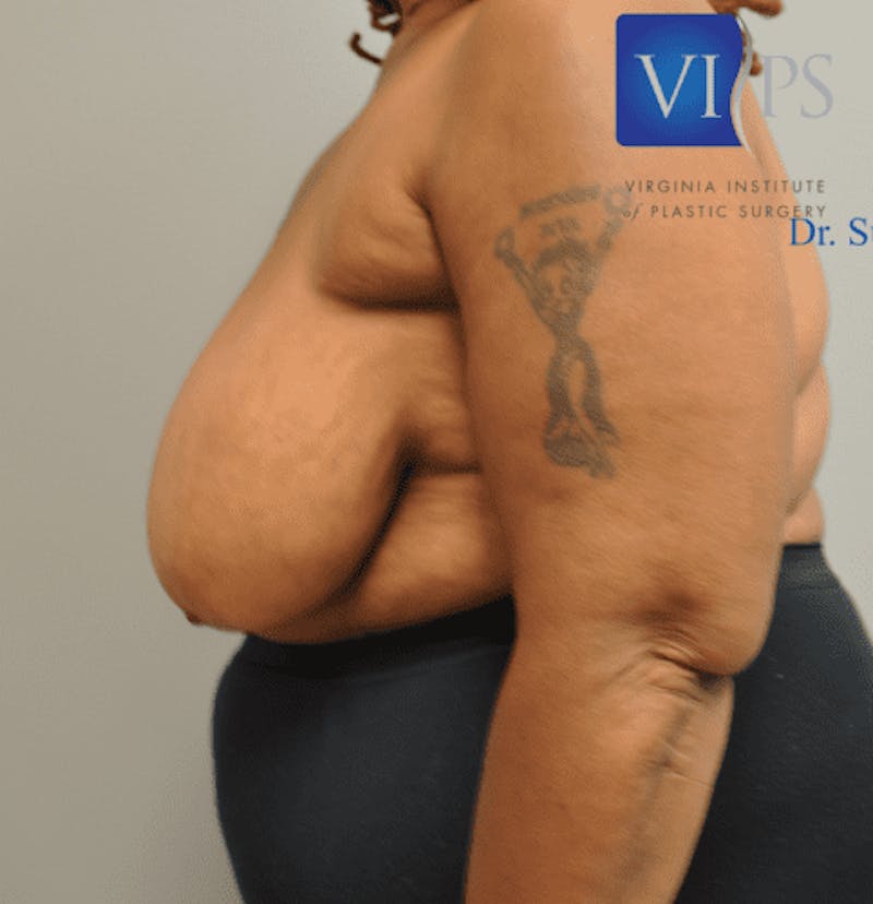 Breast Reduction Before & After Gallery - Patient 55345427 - Image 1