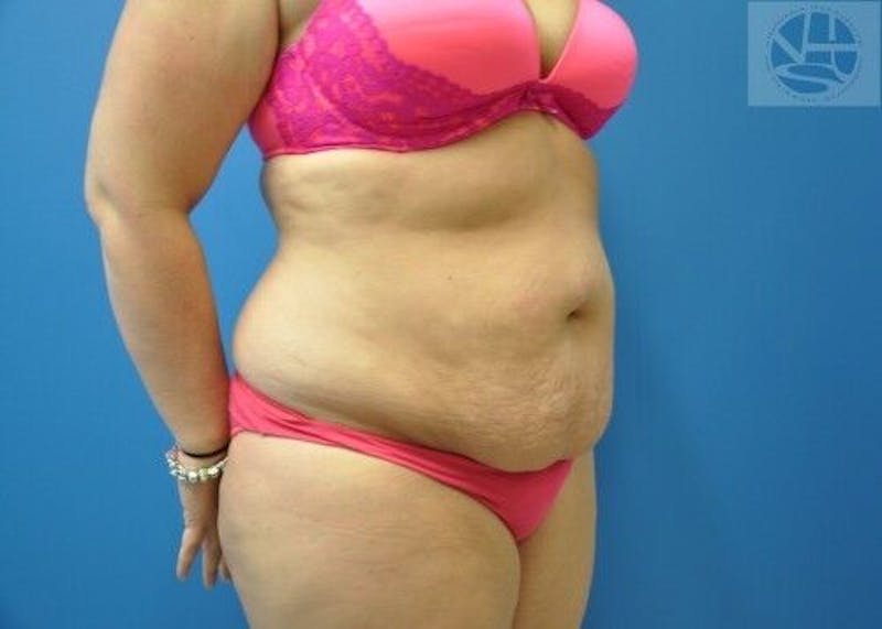 Tummy Tuck Before & After Gallery - Patient 55345429 - Image 3