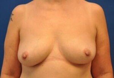 Breast Augmentation Before & After Gallery - Patient 55345428 - Image 1
