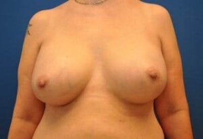 Breast Augmentation Before & After Gallery - Patient 55345428 - Image 2