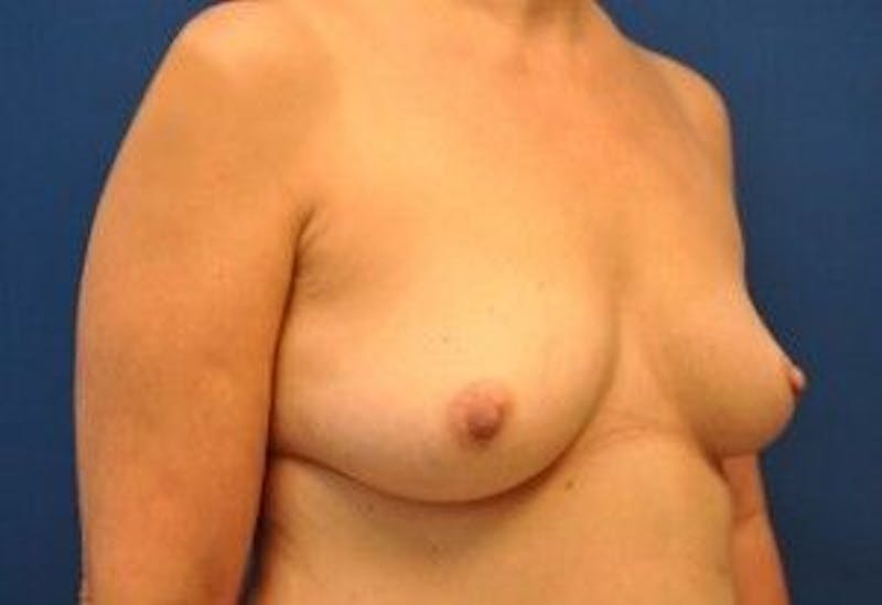 Breast Augmentation Before & After Gallery - Patient 55345428 - Image 3