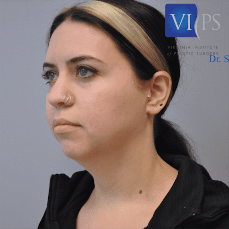 Liposuction Before & After Gallery - Patient 211876614 - Image 7