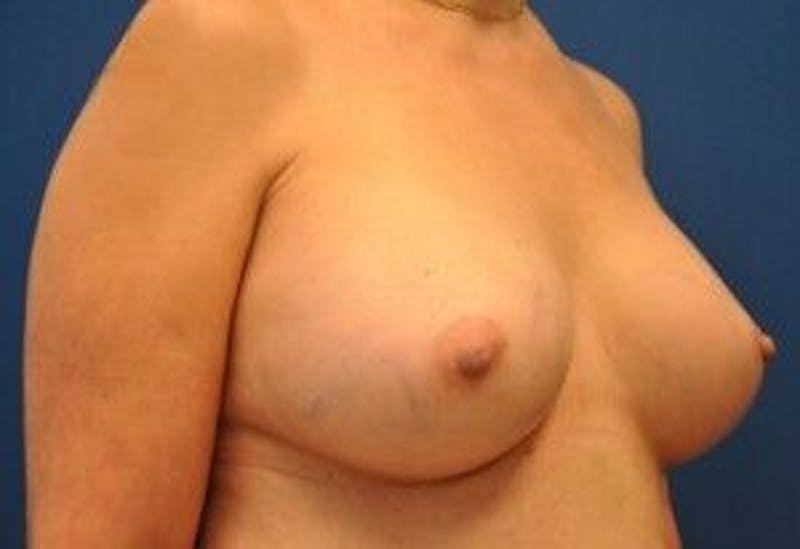 Breast Augmentation Before & After Gallery - Patient 55345428 - Image 4