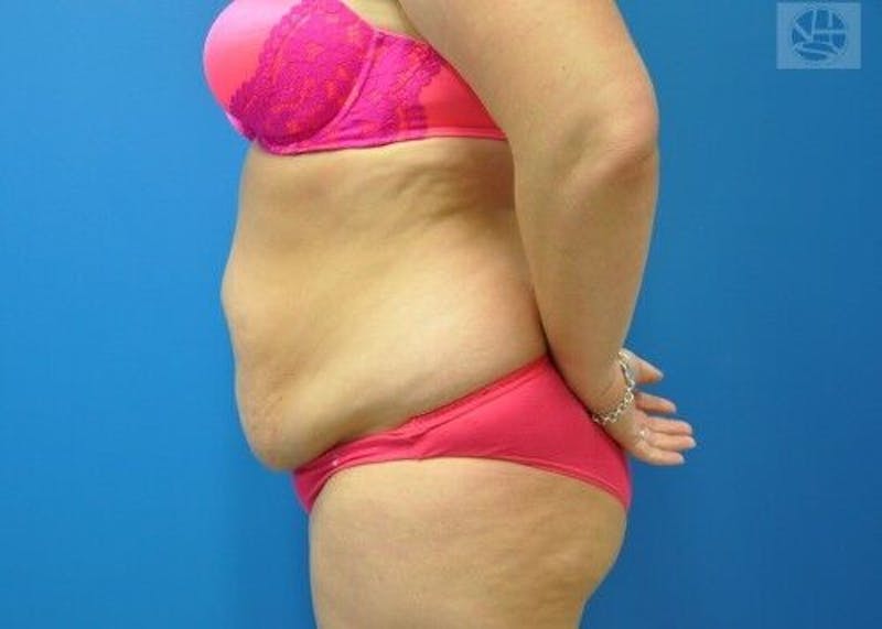 Tummy Tuck Before & After Gallery - Patient 55345429 - Image 7