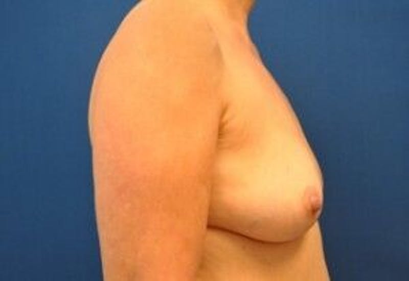 Breast Augmentation Before & After Gallery - Patient 55345428 - Image 5