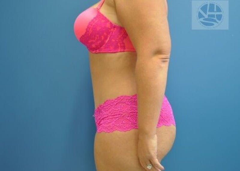Tummy Tuck Before & After Gallery - Patient 55345429 - Image 8