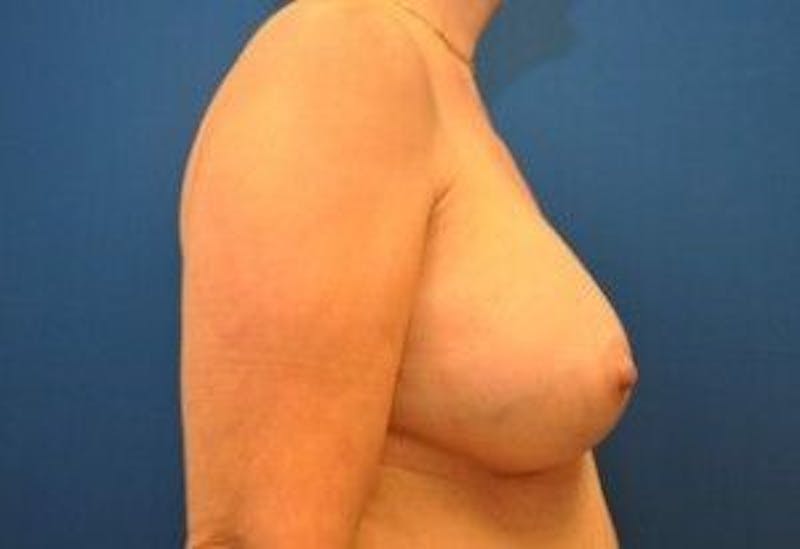 Breast Augmentation Before & After Gallery - Patient 55345428 - Image 6