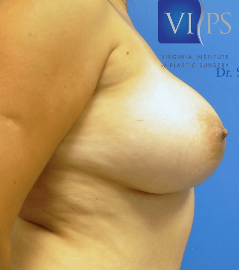 Breast Revision Before & After Gallery - Patient 55345431 - Image 3