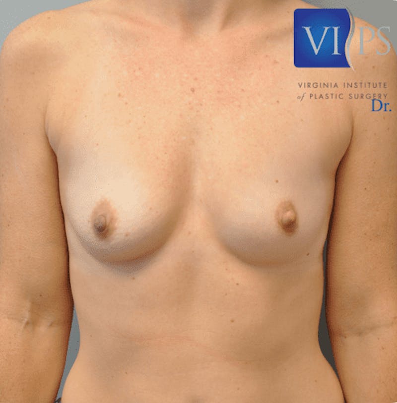 Breast Augmentation Before & After Gallery - Patient 55345439 - Image 1