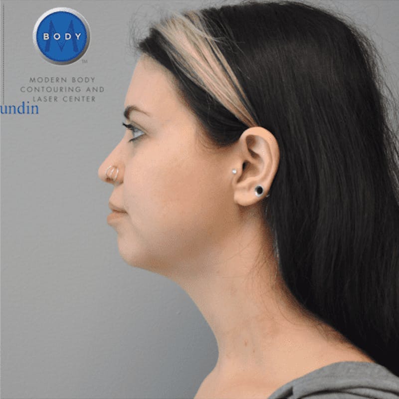 Renuvion J-Plasma Before & After Gallery - Patient 211876557 - Image 10