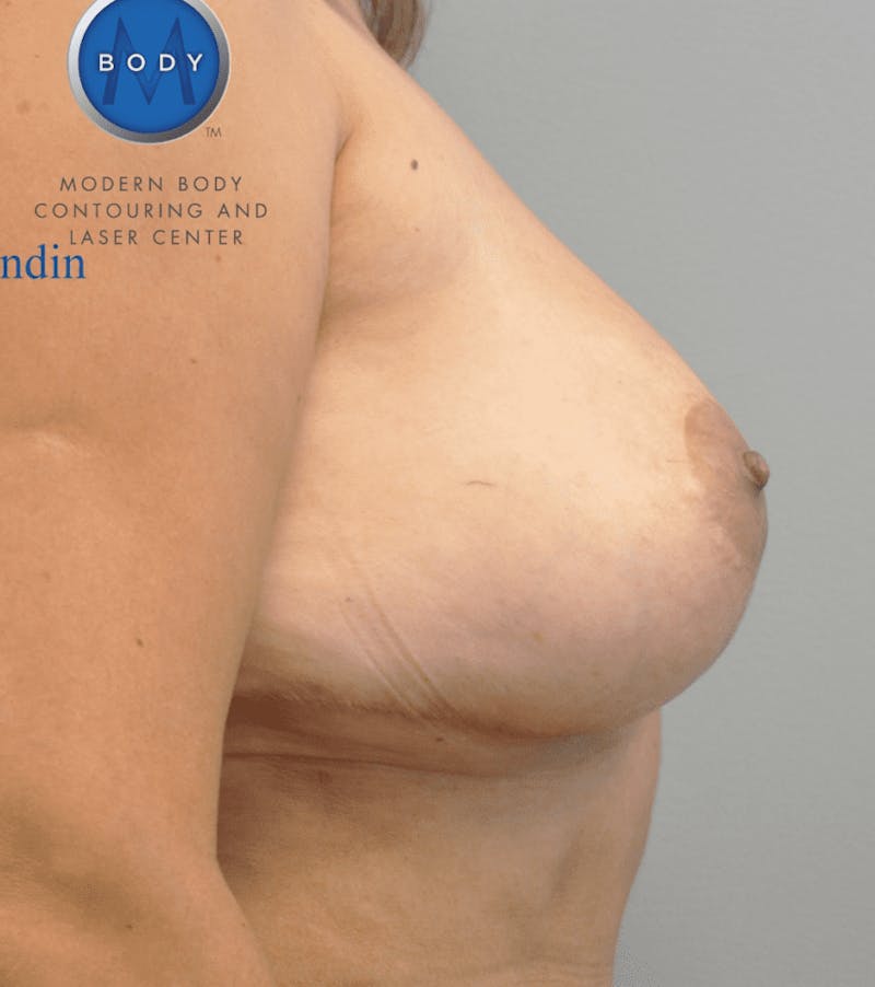 Breast Revision Before & After Gallery - Patient 55345431 - Image 4