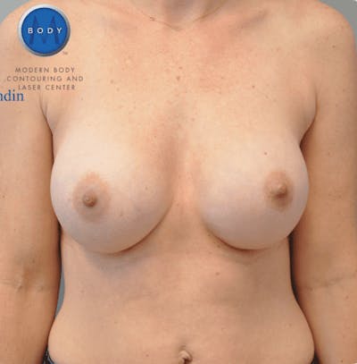 Breast Augmentation Before & After Gallery - Patient 55345439 - Image 2