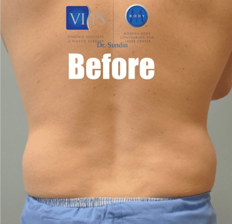 Liposuction Before & After Gallery - Patient 55345440 - Image 1