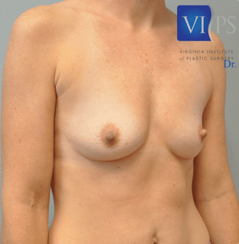 Breast Augmentation Before & After Gallery - Patient 55345439 - Image 3
